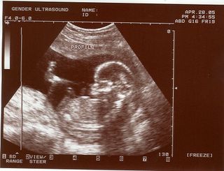 Fetus.jpg ultrasound fetus baby tiny dancer